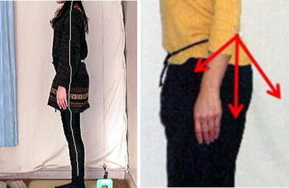 安静立位時の骨盤の状態を細線化処理で表現します。