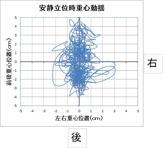 めまいの方の安静立位時の重心バランスです。